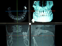 歯科用CT