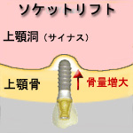 ソケットリフト