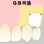 GBR（骨誘導再生）