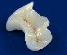 歯の詰め物プレミアムセラミックインレー