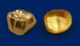 奥歯の被せ物ゴールド