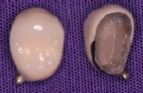 奥歯の被せ物メタルボンド