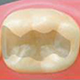 歯の詰め物
